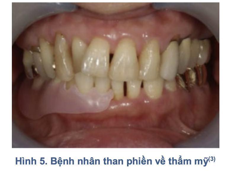 Hàm nhựa dẻo trong phục hình tháo lắp: Đặc tính, chỉ định và biến chứng lâm sàng